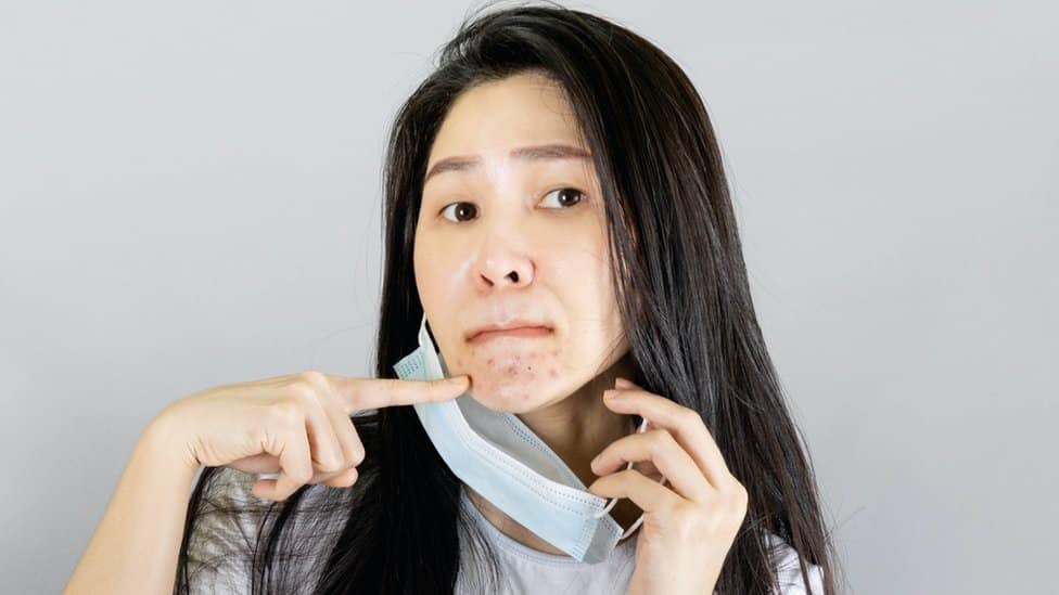 maskne, el acné por el uso de la mascarilla