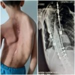 El niño venezolano que necesita enderezar su columna