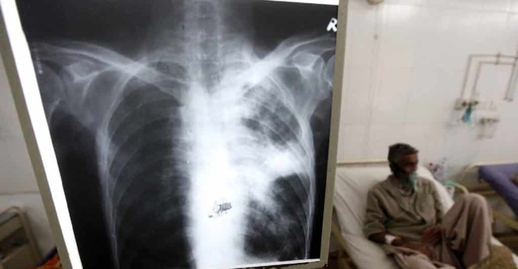 Día Mundial de la Tuberculosis: una enfermedad de la pobreza que avanza en Venezuela