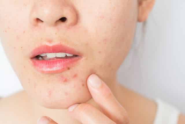 La aparición del acné es un cambio común en la piel de los migrantes