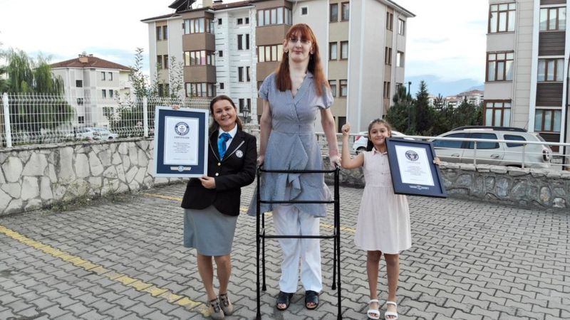Rumeysa Gelgi: qué es el síndrome de Weaver, la condición que afecta a la mujer más alta del mundo