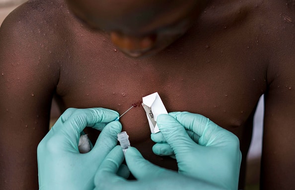 Los tratamientos y vacunas que la EMA está evaluando contra la viruela del mono