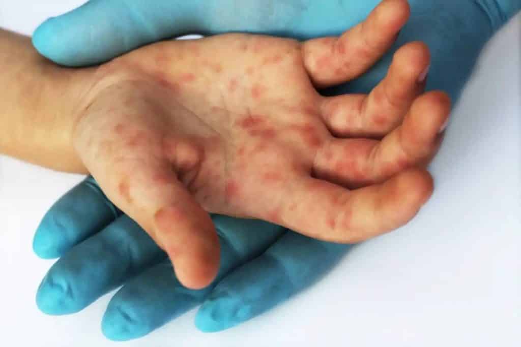 Viruela del mono: cómo saber si tienes esta u otra enfermedad que provoca síntomas similares en la piel