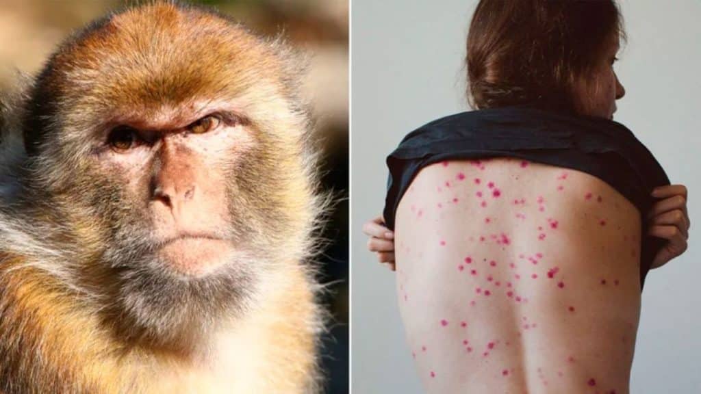 El riesgo de transmisión de la viruela del mono en Venezuela es bajo