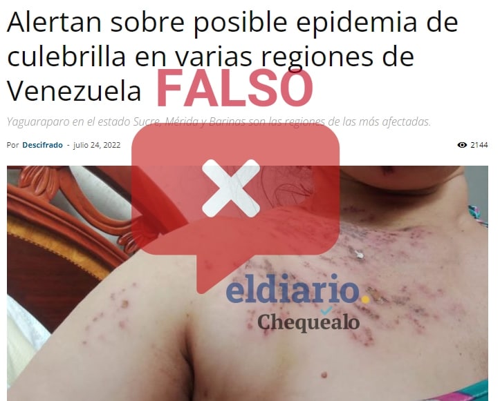 ¿Existe una alerta sobre una epidemia de herpes zóster en Venezuela?￼