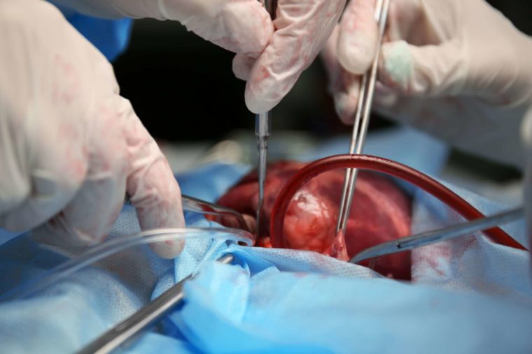 Desarrollan una tecnología para “resucitar” órganos muertos y así ganar tiempo para los trasplantes
