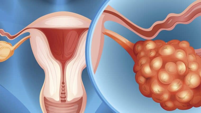 Tratamientos contra el cáncer de ovario logran una efectividad de 70 %
