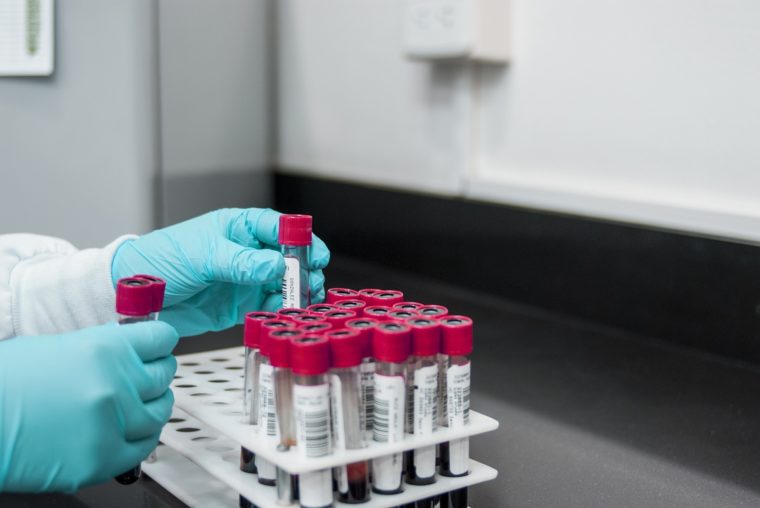 Diagnóstico de alzhéimer en pruebas de sangre: validaron 9 biomarcadores para estos exámenes
