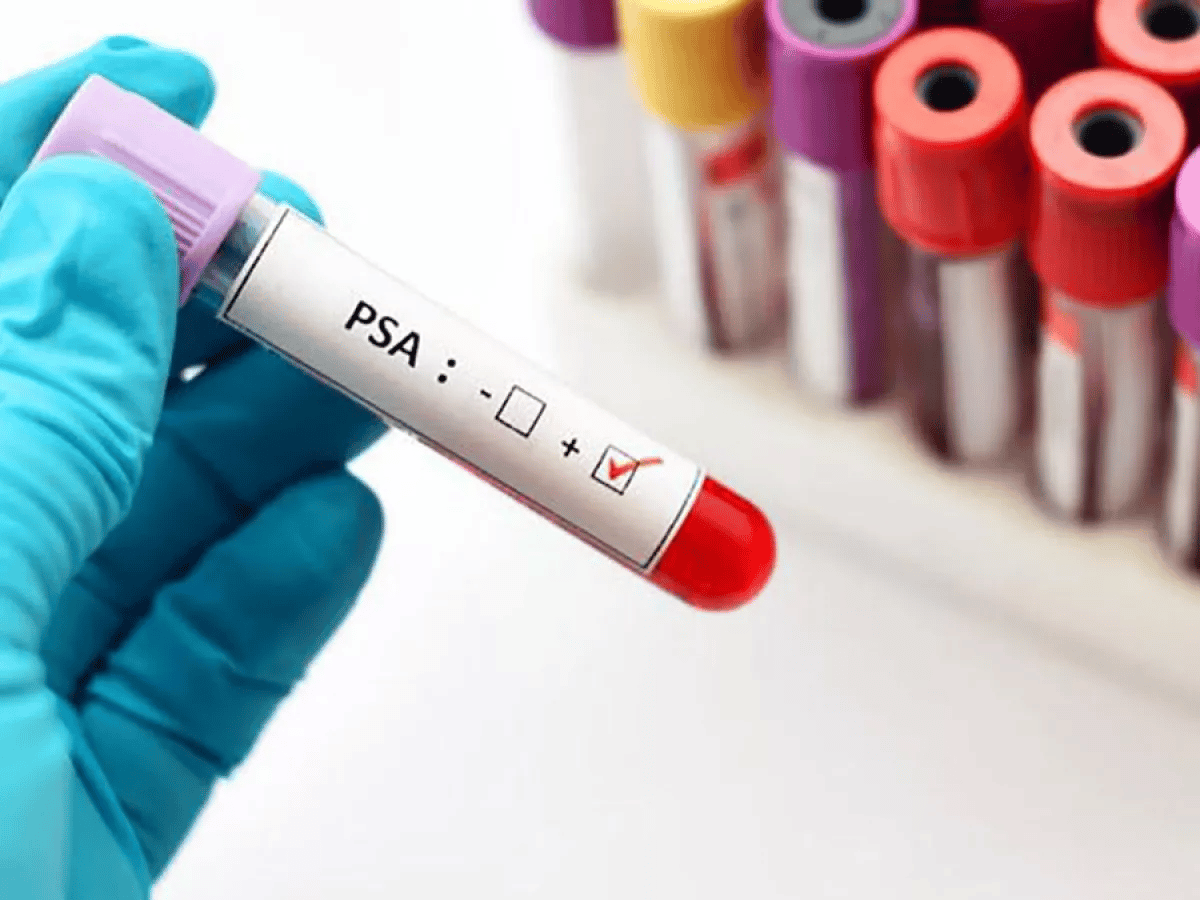Diariamente mueren 10 hombres en Venezuela por cáncer de próstata