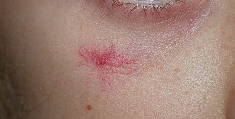 Angiomas: ¿qué son y por qué aparecen estos puntos rojos en la piel?