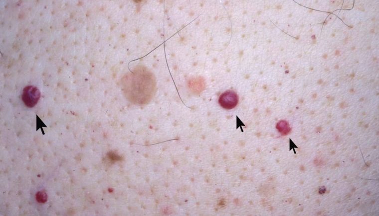 Angiomas: ¿qué son y por qué aparecen estos puntos rojos en la piel?