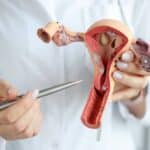 Infecciones por VPH de alto riesgo oncogénico afecta a 3 de cada 10 venezolanas