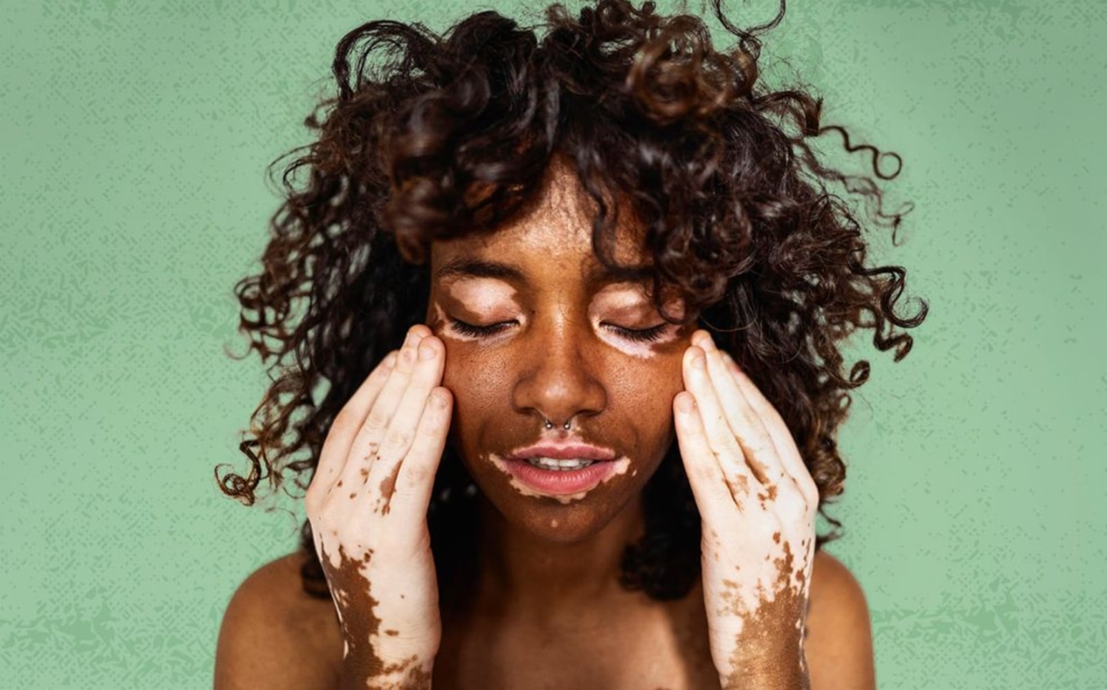 Vitiligo: ¿cuáles son los síntomas y cómo se puede tratar?