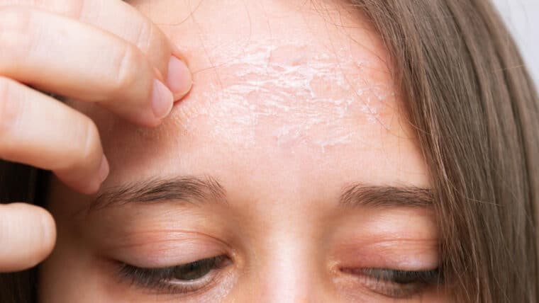 Cáncer de piel: cuáles son las zonas más vulnerables del rostro y cómo protegerlas