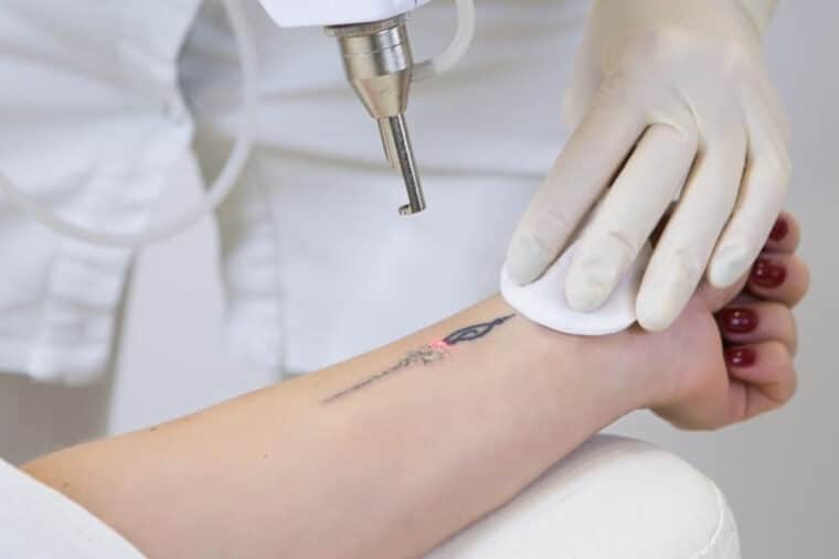 Procedimientos para quitar un tatuaje: riesgos y efectos secundarios