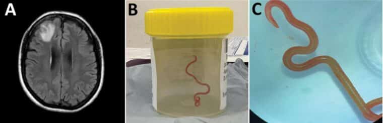 Médicos encontraron una lombriz viva en el cerebro de una mujer en Australia