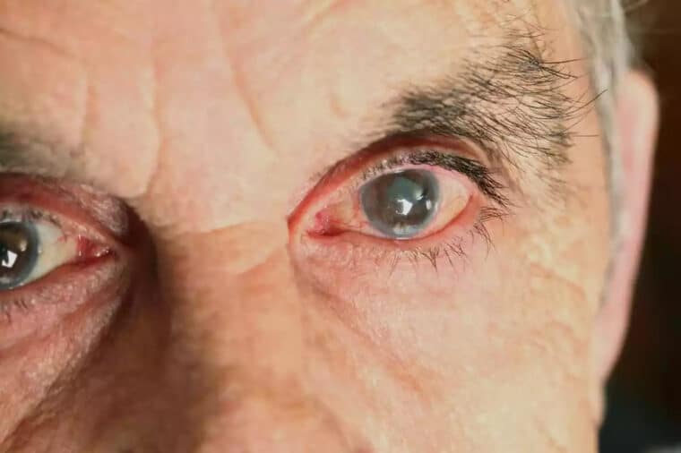 Cataratas: ¿de qué trata y cómo prevenir esta afección en los ojos?