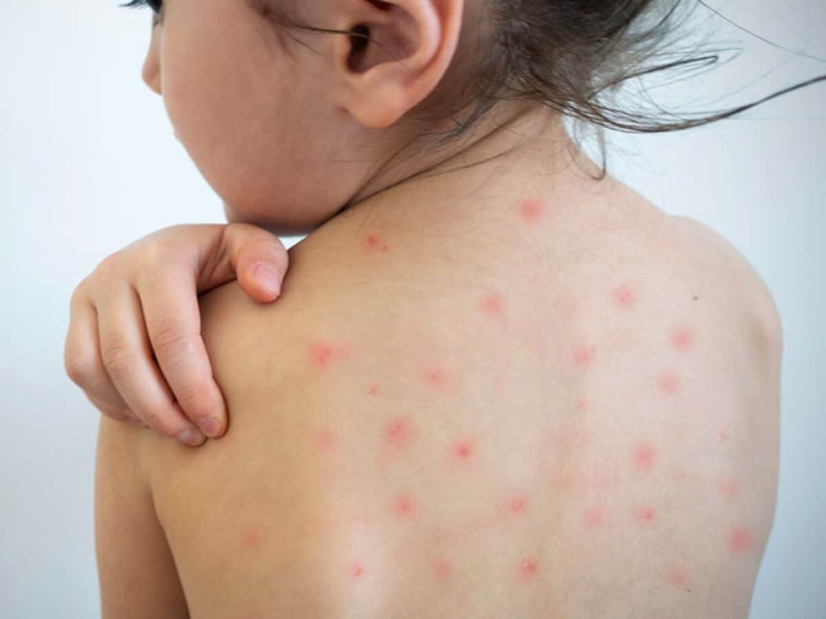 La OMS advirtió que la amenaza del sarampión sigue creciendo por falta de vacunación