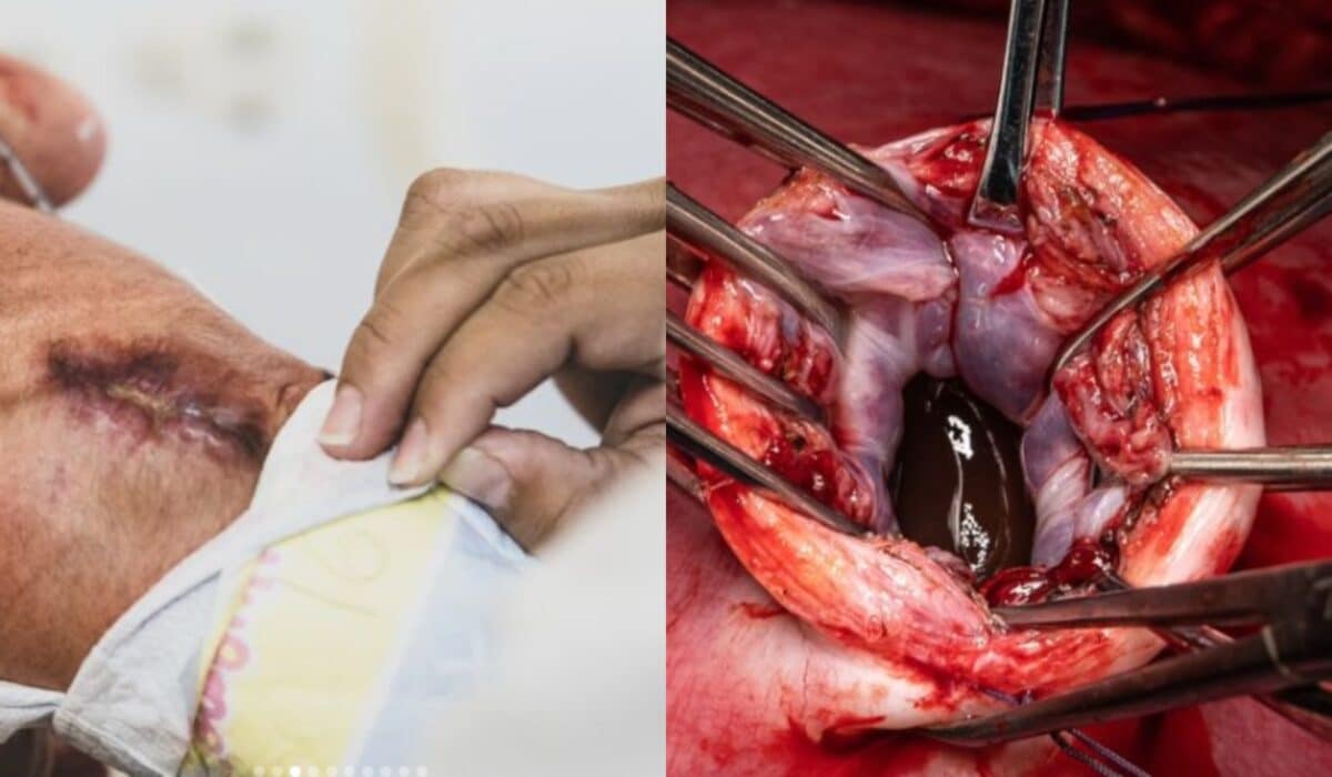 Nació el primer bebé operado a través de una microneurocirugía intrauterina en Venezuela