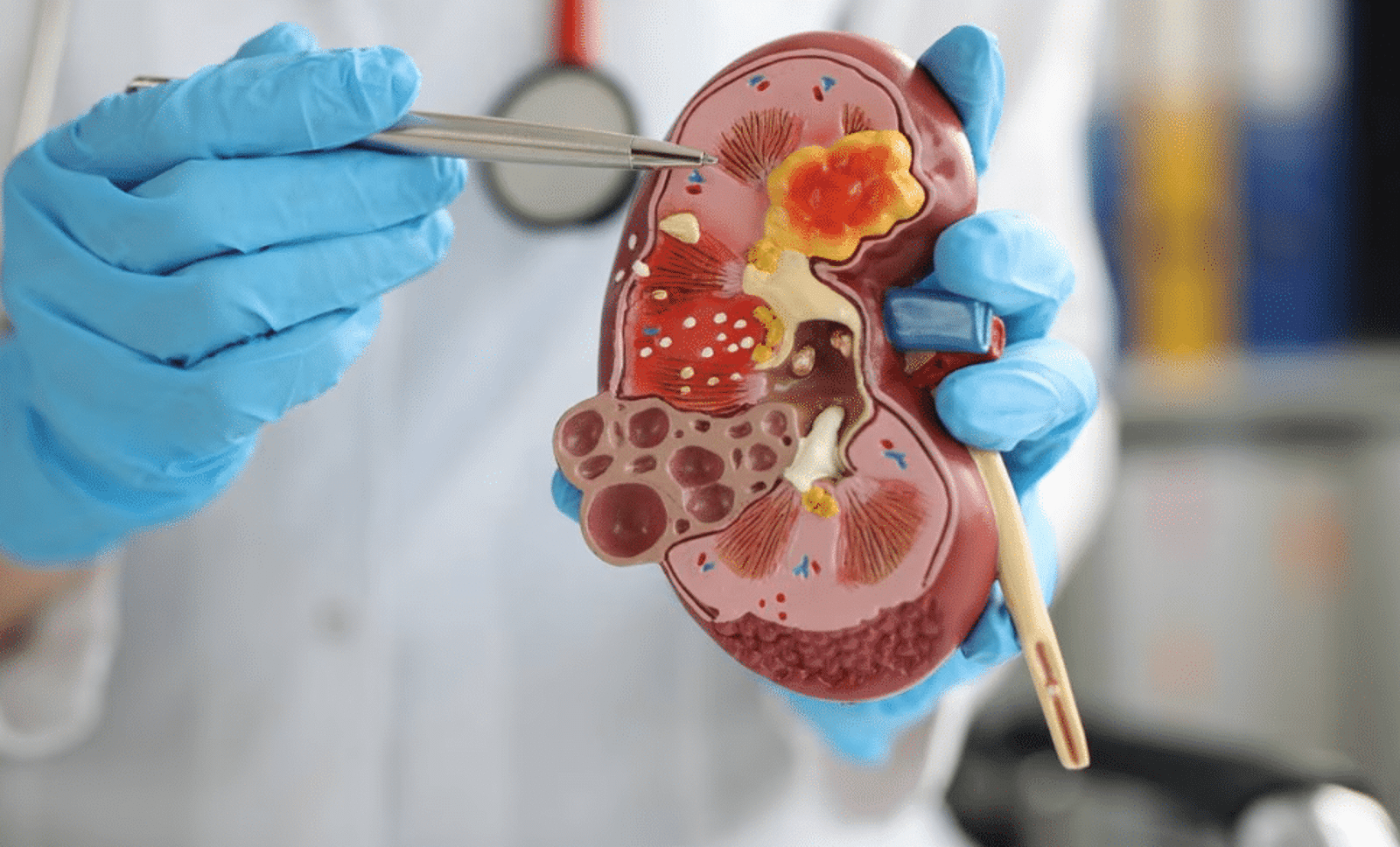 Enfermedades comunes de los riñones: síntomas y tratamiento 