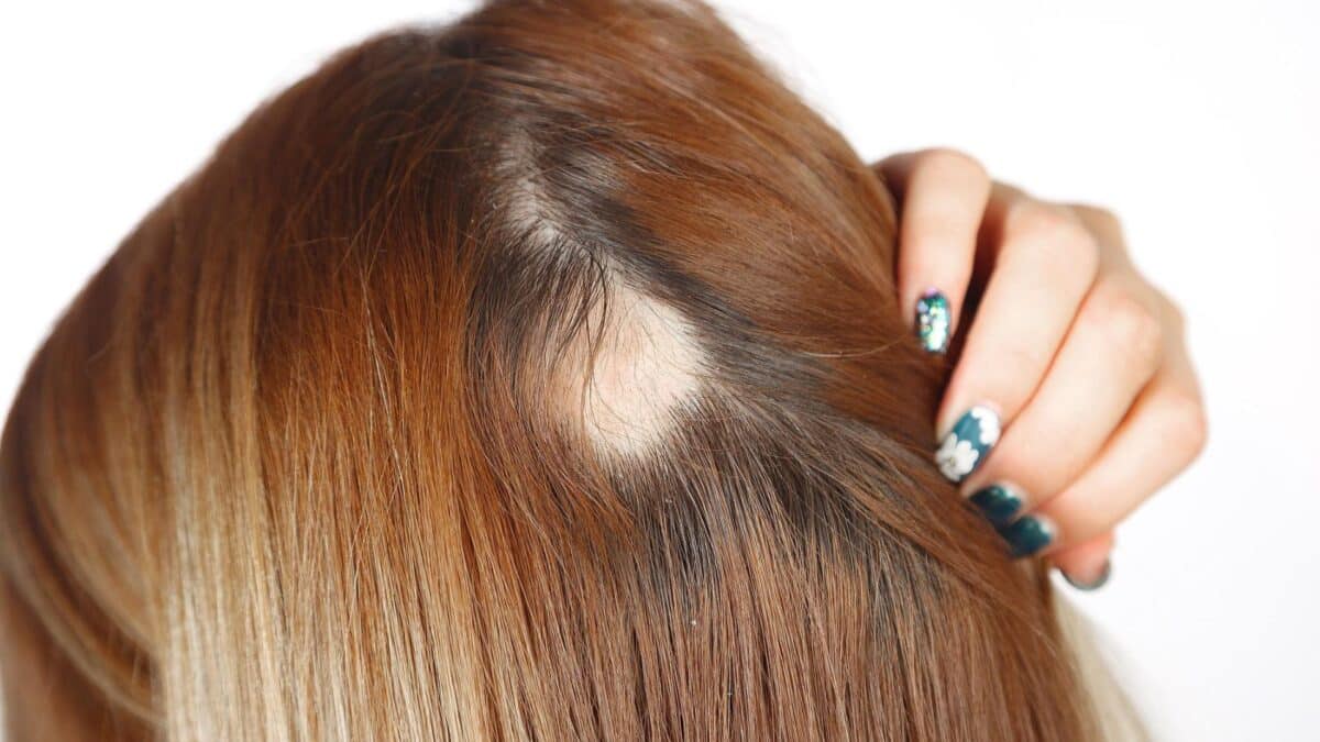 Las causas de la caída del cabello en mujeres y sus tratamientos 