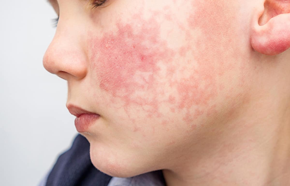 ¿Cuáles son los síntomas de la dermatomiositis juvenil, una enfermedad autoinmune que afecta a menores de 16 años? 