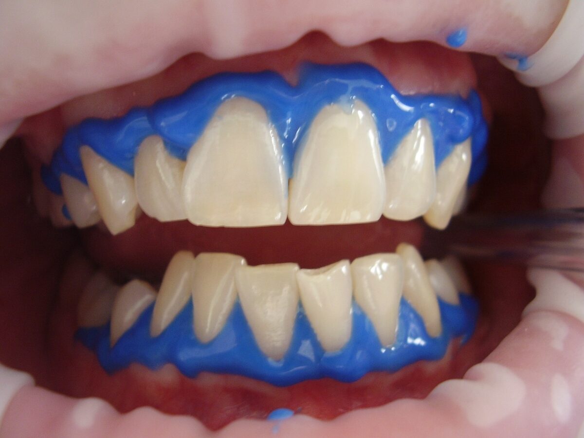 Blancorexia: ventajas y riesgos del blanqueamiento dental