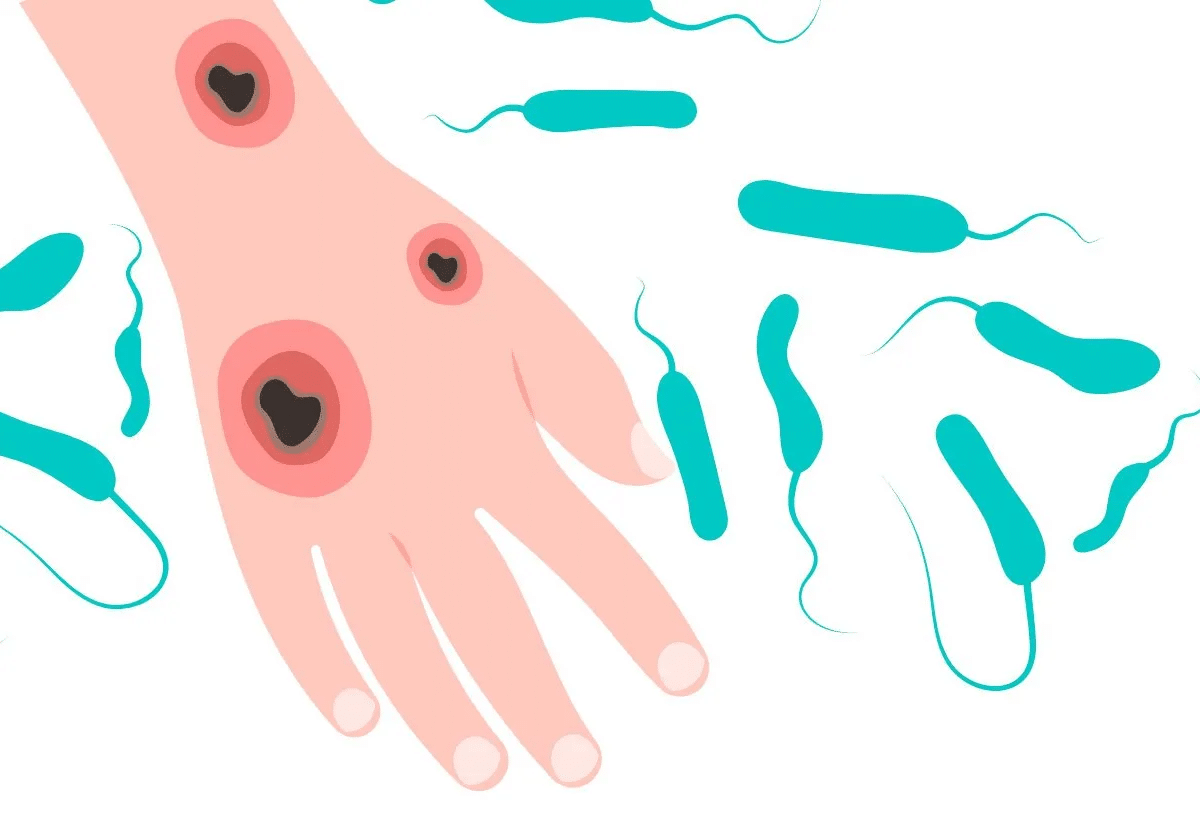 El síndrome de shock tóxico estreptocócico: lo que se sabe sobre esta infección bacteriana en Japón