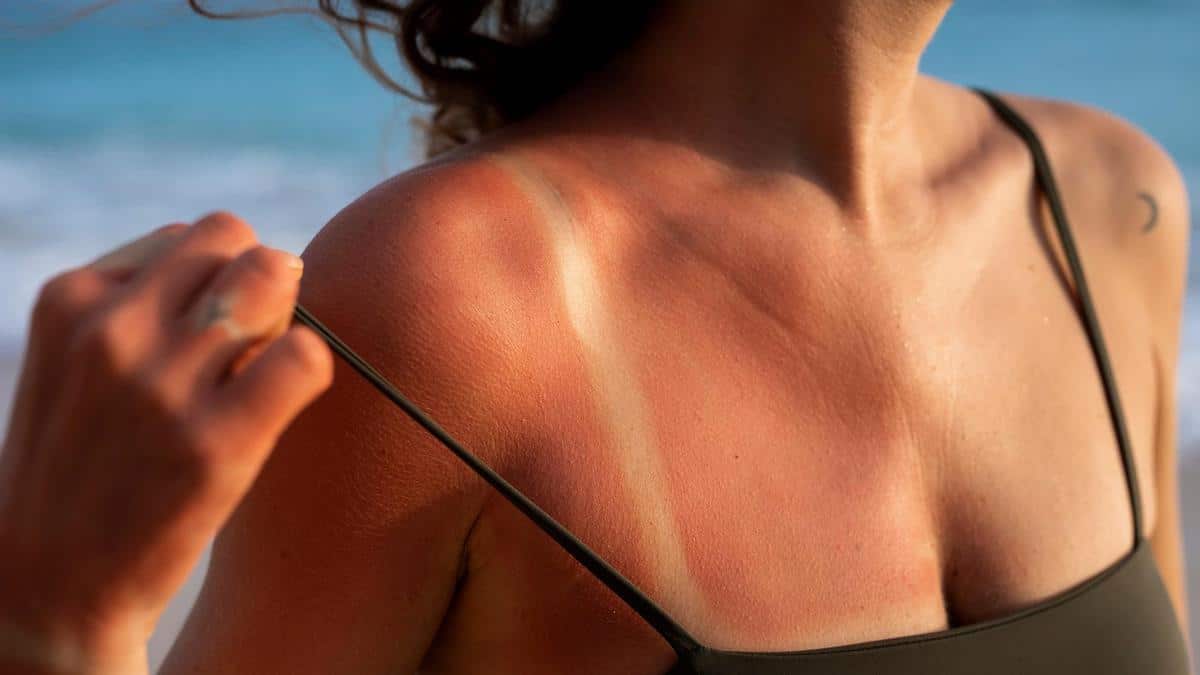 Callo solar: ¿en qué consiste esta tendencia y cuáles son los riesgos?