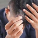 Minoxidil: ¿qué dicen los médicos sobre su uso para tratar la alopecia?
