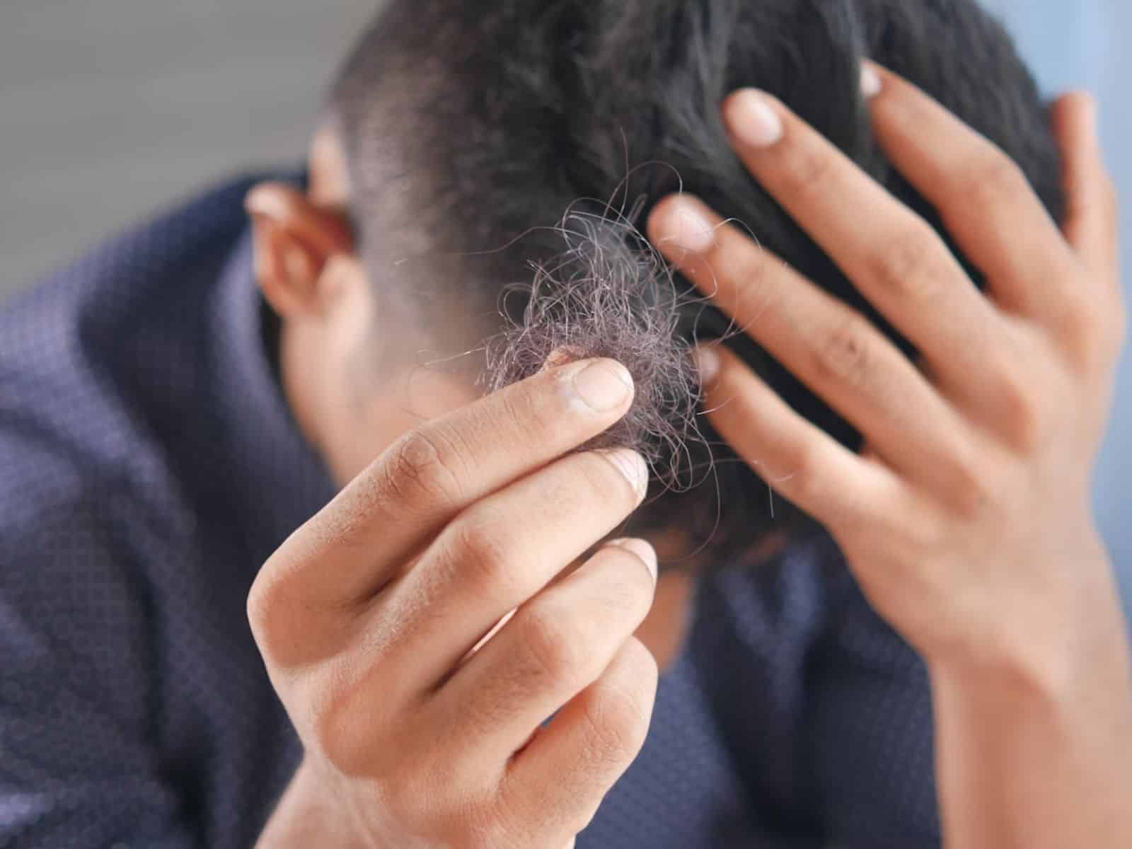 Minoxidil: ¿qué dicen los médicos sobre su uso para tratar la alopecia?