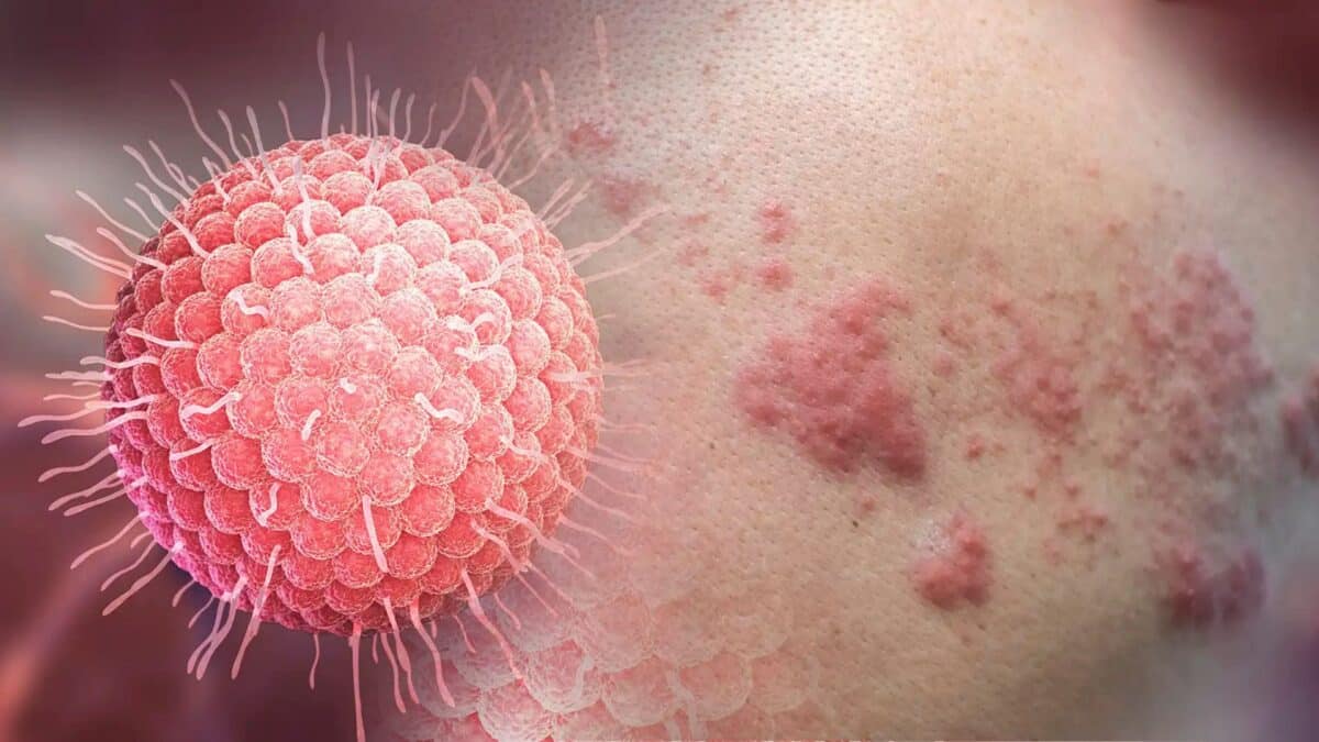 ¿Qué es la culebrilla y qué mitos hay detrás de esta infección viral en la piel? 