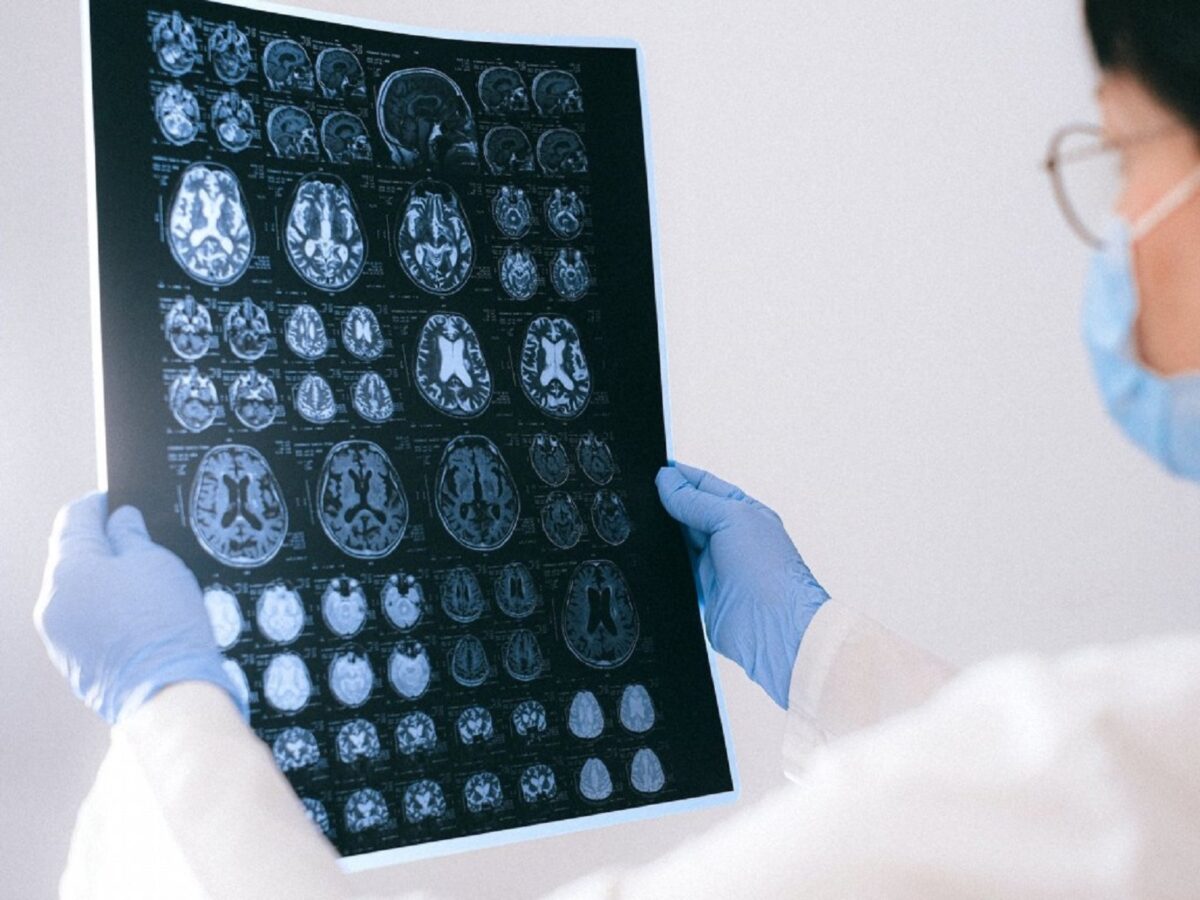 Identificaron biomarcadores para la detección temprana del alzhéimer en personas con síndrome de Down