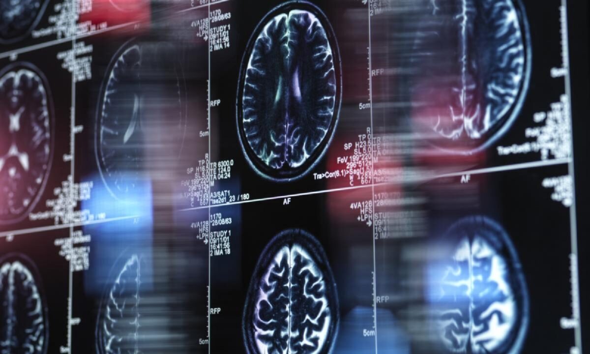 Identificaron biomarcadores para la detección temprana del alzhéimer en personas con síndrome de Down