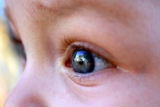 Qué es el retinoblastoma, un tipo de cáncer infantil que se manifiesta en los ojos