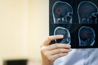 La contaminación del aire podría aumentar el riesgo de desarrollar tumores cerebrales