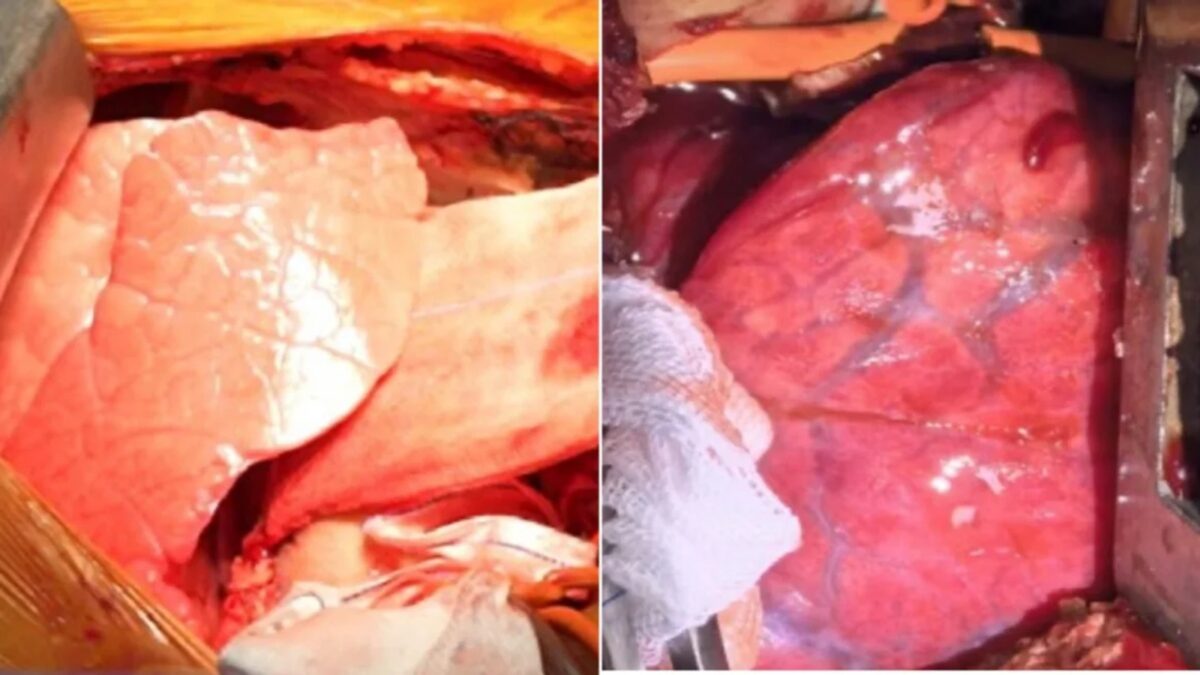 Médicos en China trasplantaron por primera vez un pulmón de cerdo a un hombre con muerte cerebral  