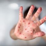 OPS reportó más de 10 mil casos de sarampión en América durante 2025
