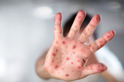 OPS reportó más de 10 mil casos de sarampión en América durante 2025