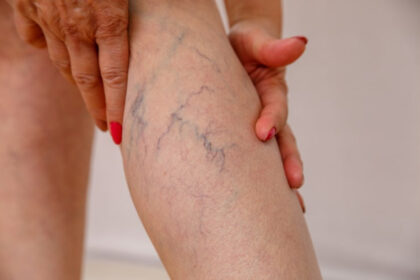 Varices vs. arañas vasculares: diferencias, síntomas y tratamiento 