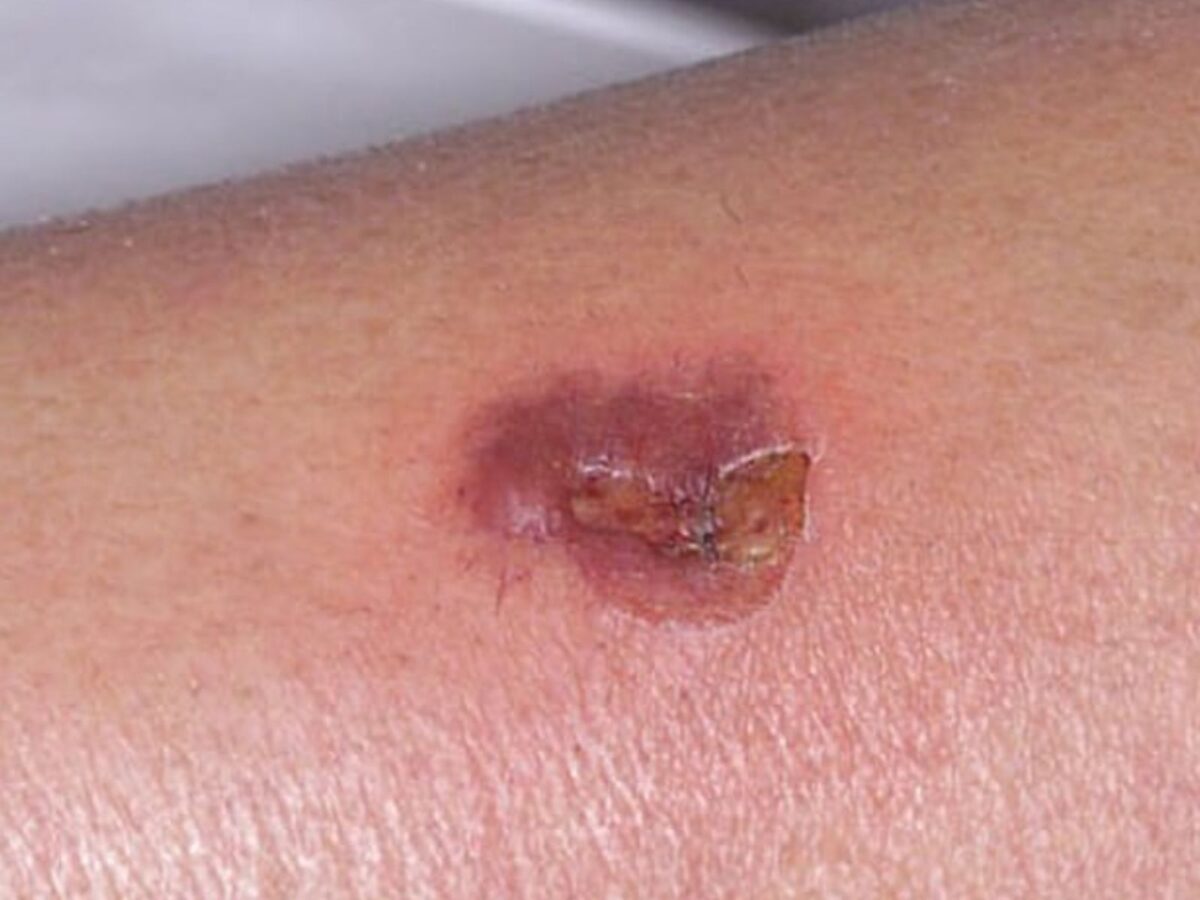 ¿Qué es la brasa, la enfermedad de la que reportaron brotes en Delta Amacuro?