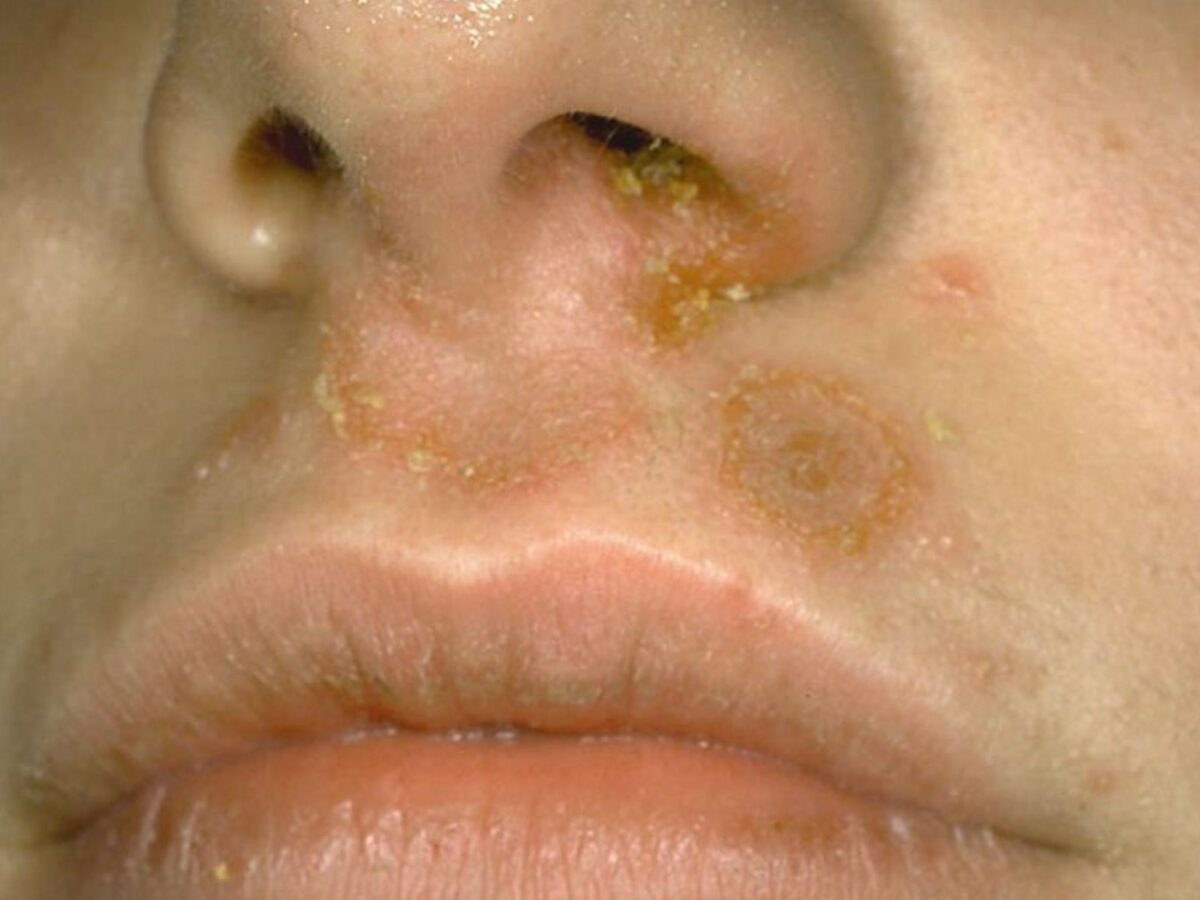 ¿Qué es la brasa, la enfermedad de la que reportaron brotes en Delta Amacuro?