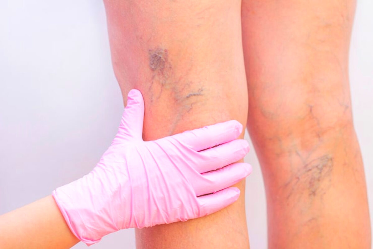 Varices vs. arañas vasculares: diferencias, síntomas y tratamiento 