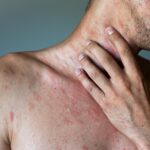 ¿Qué es la urticaria crónica, cómo se manifiesta y cuál es su tratamiento? 