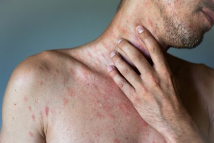 ¿Qué es la urticaria crónica, cómo se manifiesta y cuál es su tratamiento? 