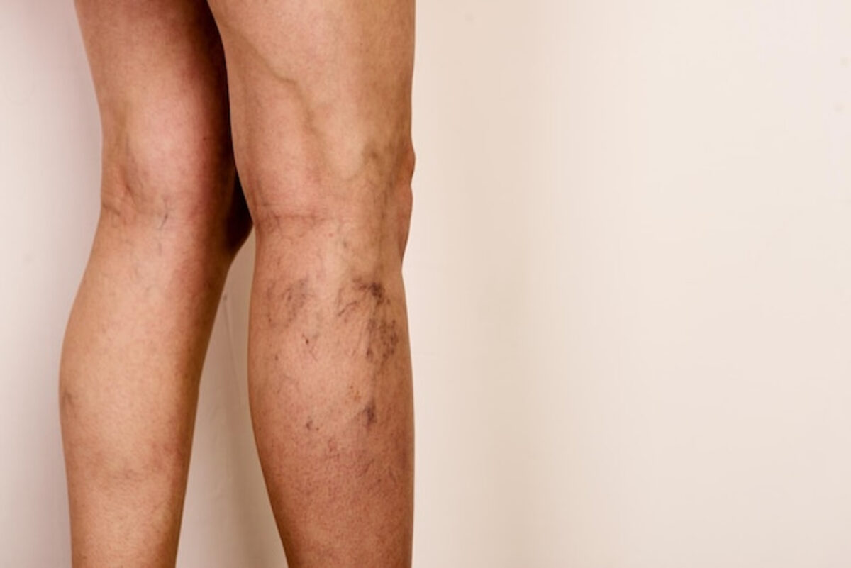 Varices vs. arañas vasculares: diferencias, síntomas y tratamiento 