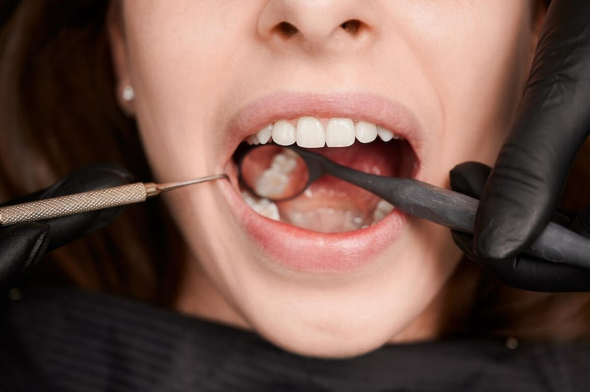 Caries activas o inactivas: diferencias y tratamientos para cada caso