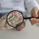 ¿Qué es un aneurisma cerebral y por qué se produce?