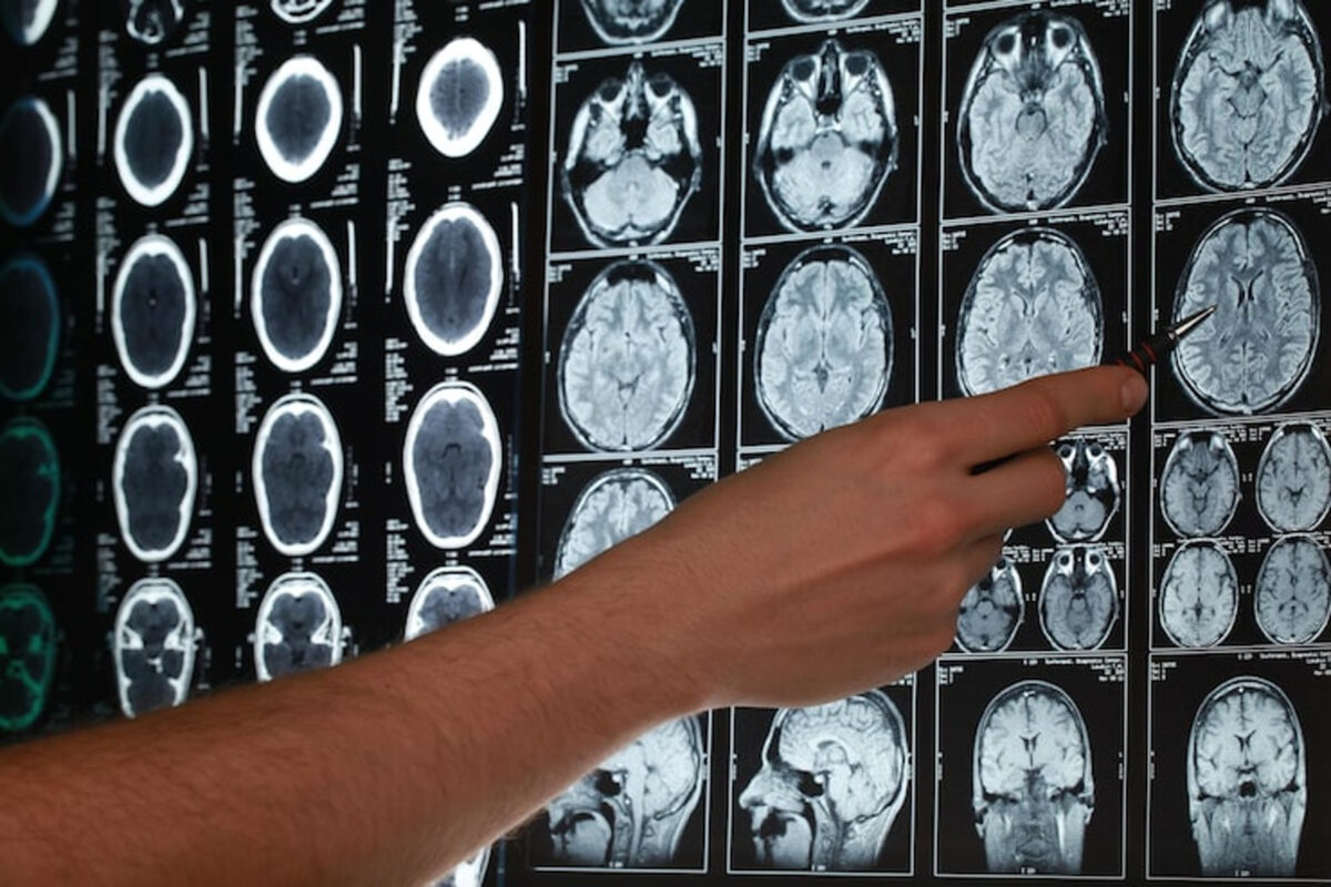 ¿Qué es un aneurisma cerebral y por qué se produce?