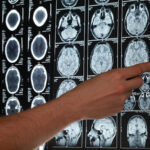 El “gen venezolano”: una rara mutación bajo investigación médica internacional